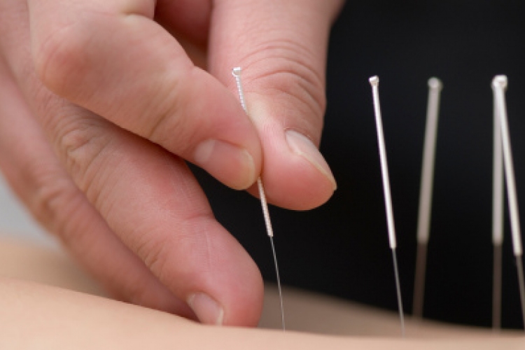 Akupunktúrával a szénanátha ellen
